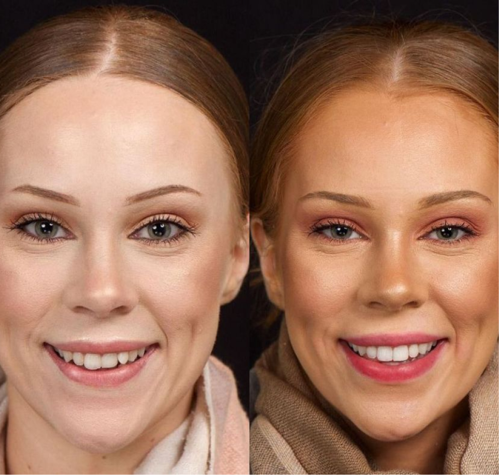 Before and after clear aligner treatment