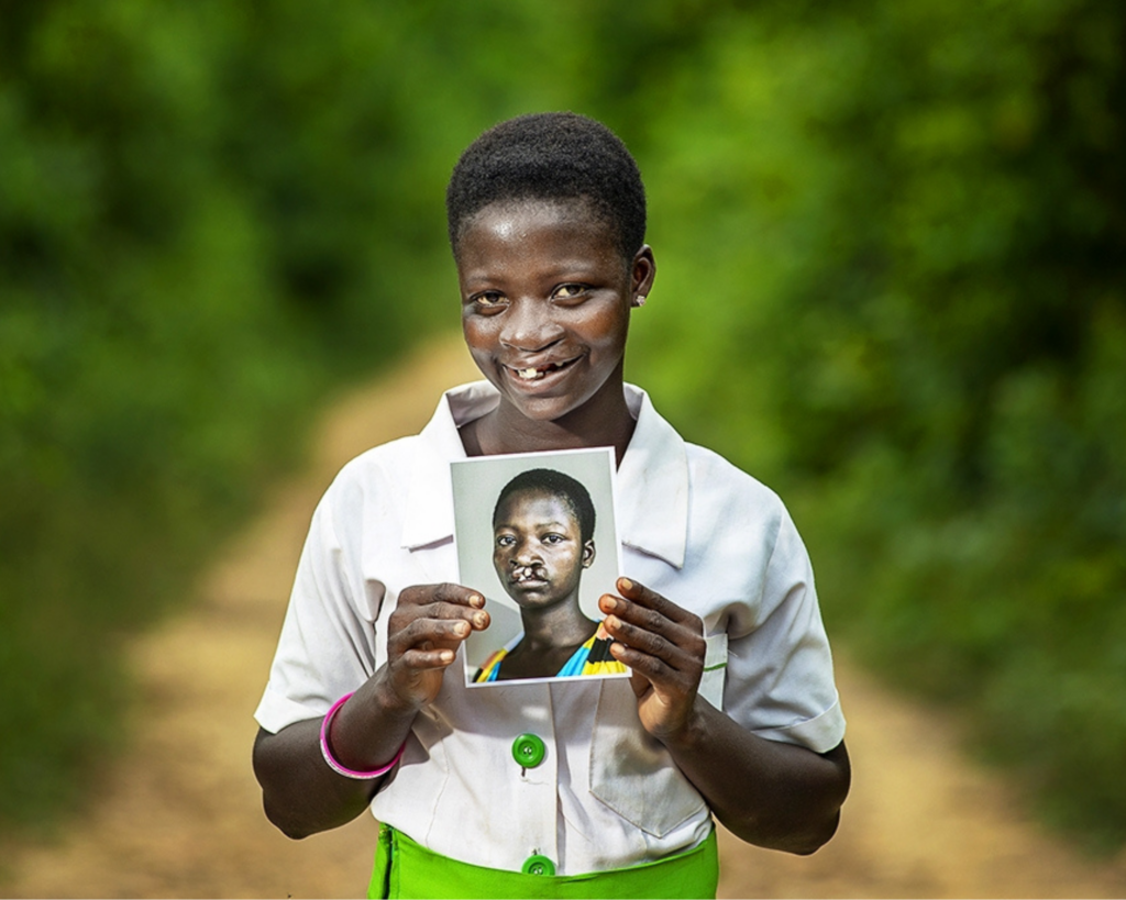 Faustina, an Operation Smile patient, smiling after free cleft surgery