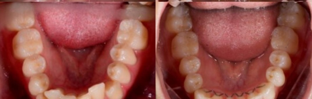 Lower arch before and after Active Aligners, a third patient case: crowded lower teeth aligned, with a bonded retainer holding the result