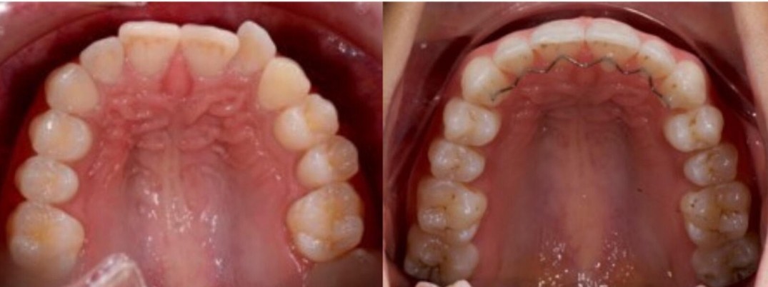 Upper arch before and after Active Aligners, a third patient case: crowded teeth become an evenly aligned arch