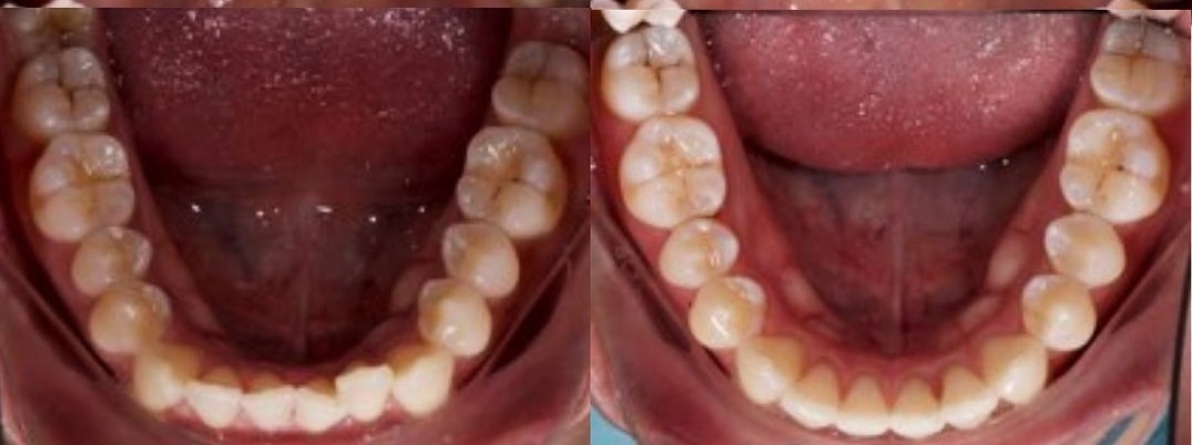 Lower arch before and after Active Aligners, a fourth patient case: crowded lower incisors brought into an even line