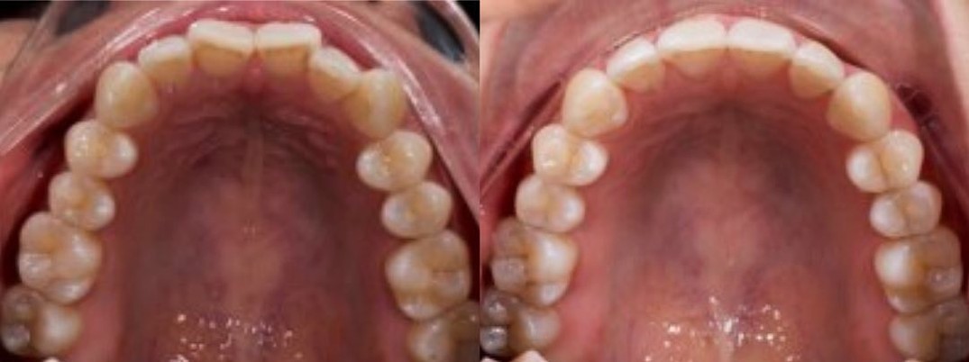 Upper arch before and after Active Aligners, a fourth patient case: the arch is widened and evened out after treatment