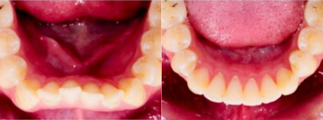 Lower arch before and after Active Aligners, showing teeth moving from crowded to evenly aligned