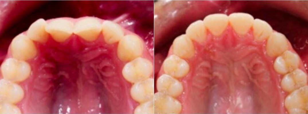 Upper arch before and after Active Aligners, showing teeth moving from crowded to evenly aligned