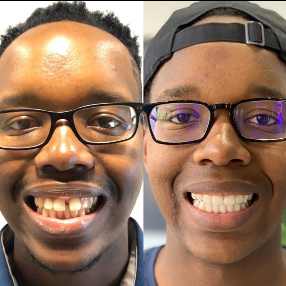 Real Active Aligners patient, before and after: crowded and gapped teeth become an even, straight smile