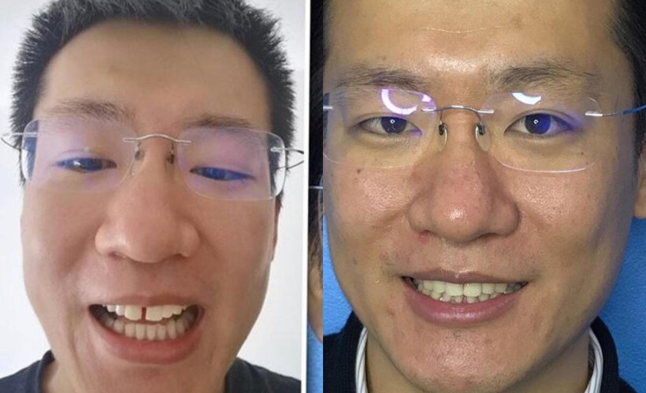Real Active Aligners patient, before and after: a front-tooth gap closes into an even smile
