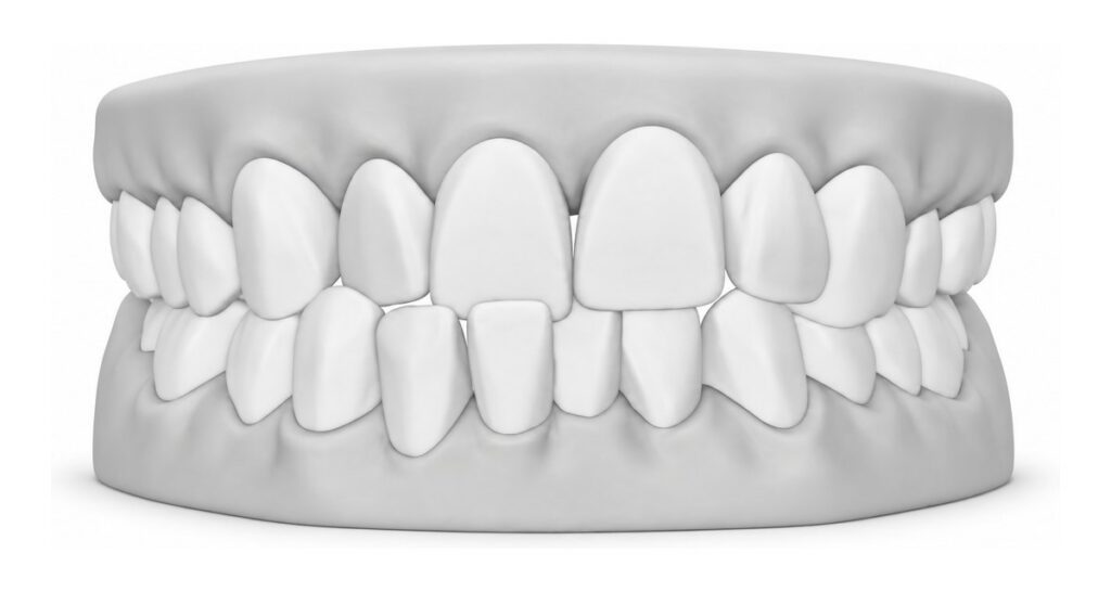 3D dental model showing a crossbite, where some upper teeth bite behind the lower teeth