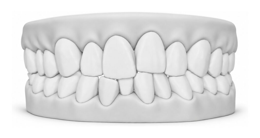 3D dental model showing crowded teeth, with overlapping and rotated front teeth