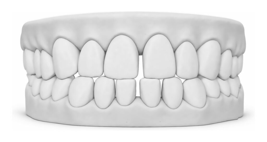 3D dental model showing gaps between the teeth, including a space between the upper front teeth