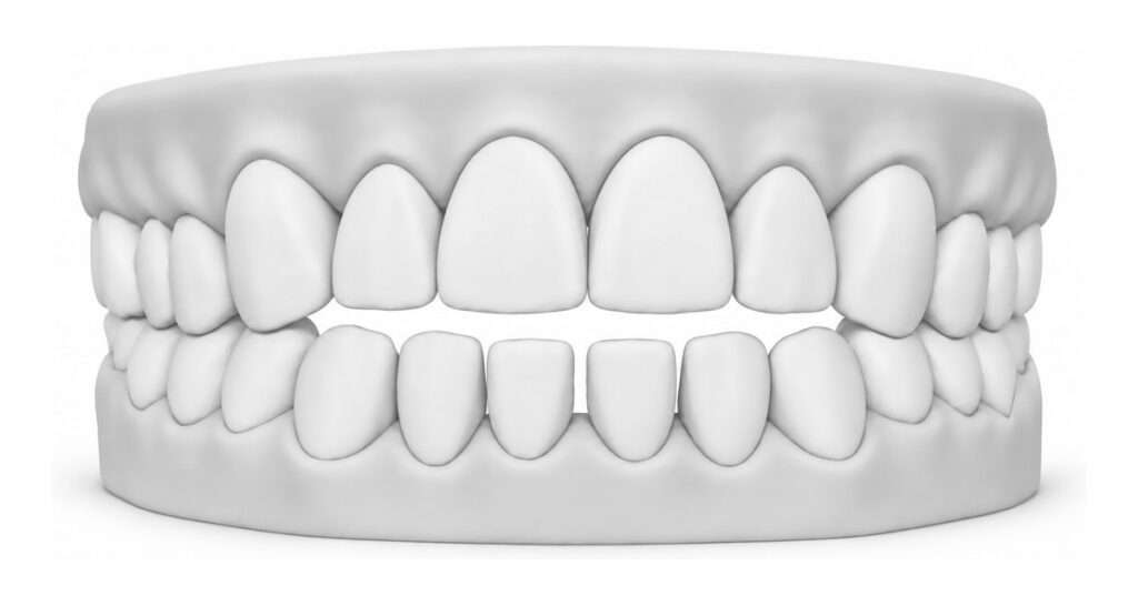 3D dental model showing an open bite, with a gap between the upper and lower front teeth when biting down