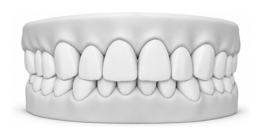3D dental model showing an overbite, with the upper front teeth covering much of the lower teeth