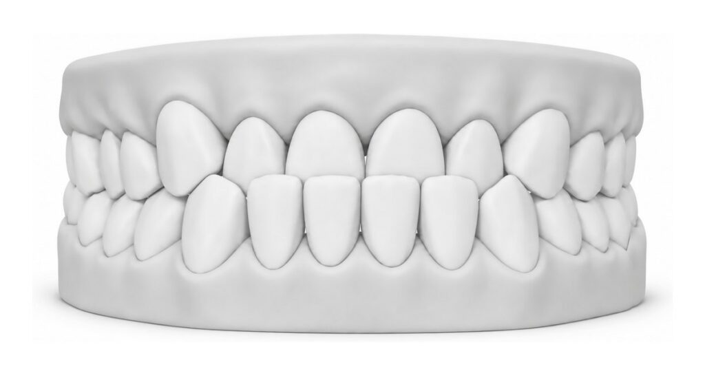 3D dental model showing an underbite, with the lower front teeth sitting ahead of the upper teeth
