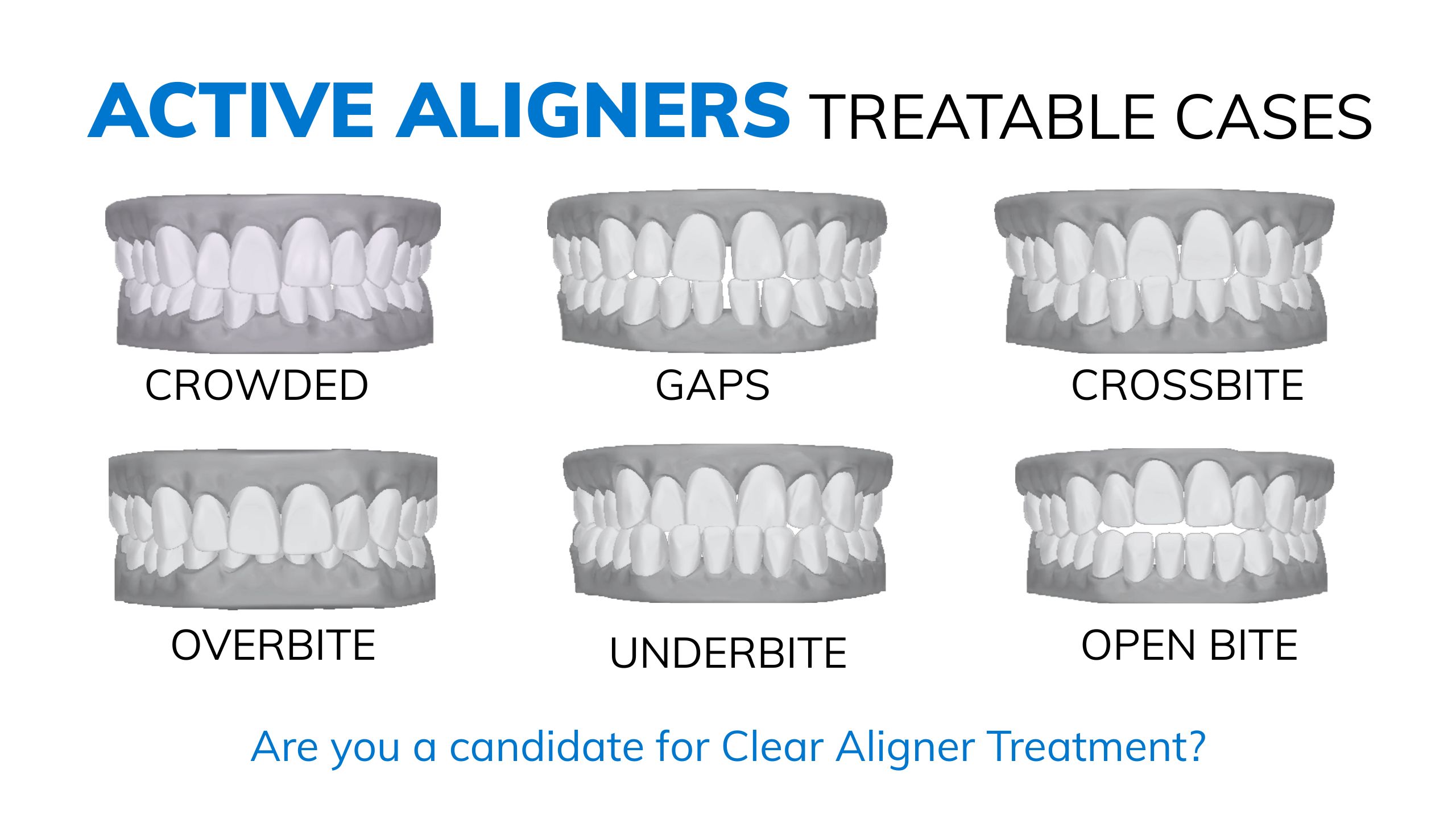 Illustration of types of occlusions treatable with Active Aligners